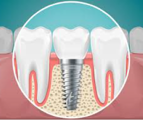 インプラントイラスト